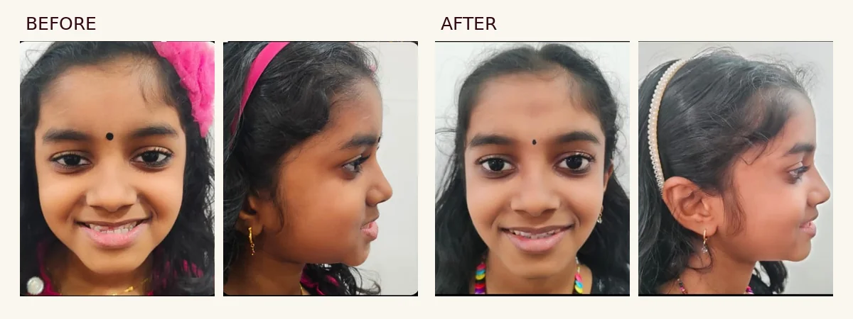 Before and after frontal and profile photographs for an interceptive orthodontic case using a dentofacial orthopaedic appliance