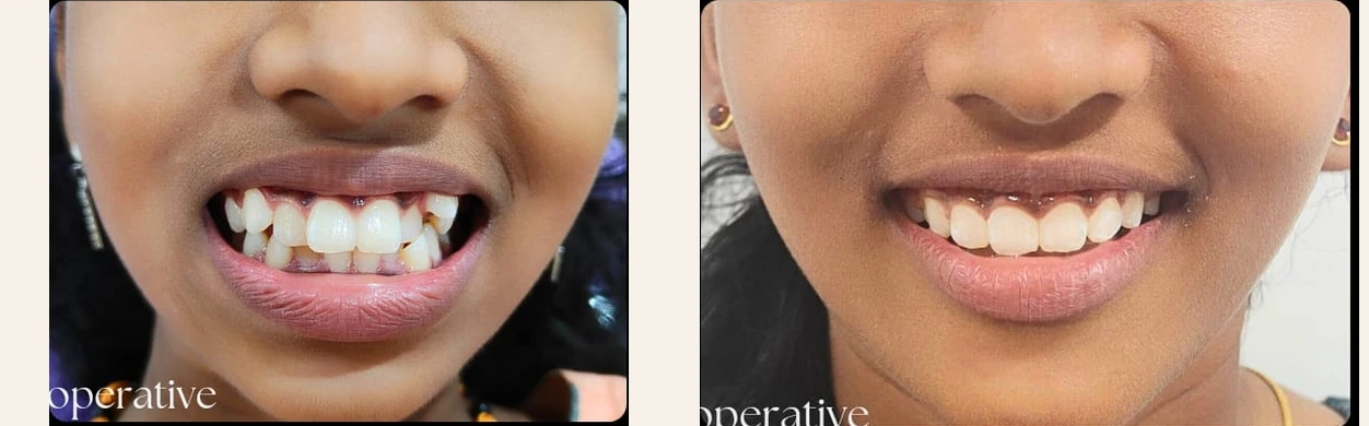 Orthodontic treatment case with pre-treatment and later smile photographs